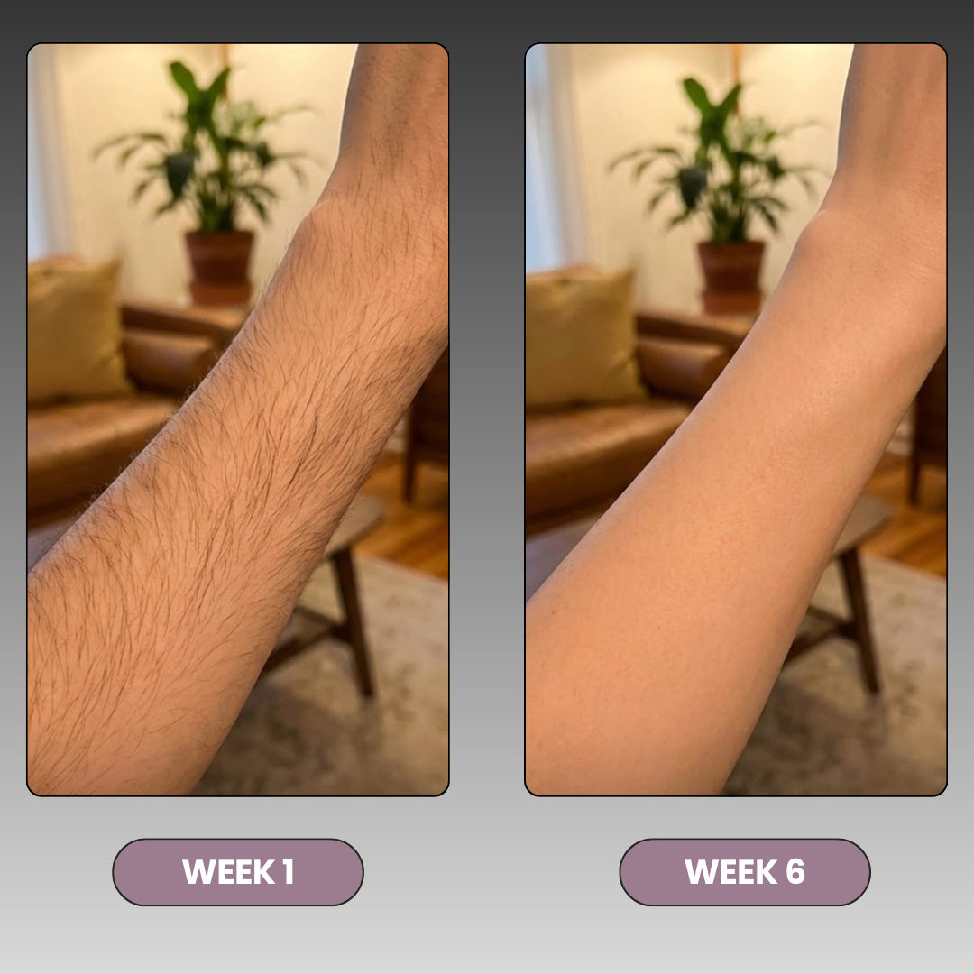 Permanent Hair Removal Device