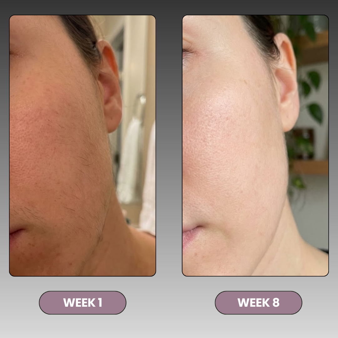 Hair Removal Epilator